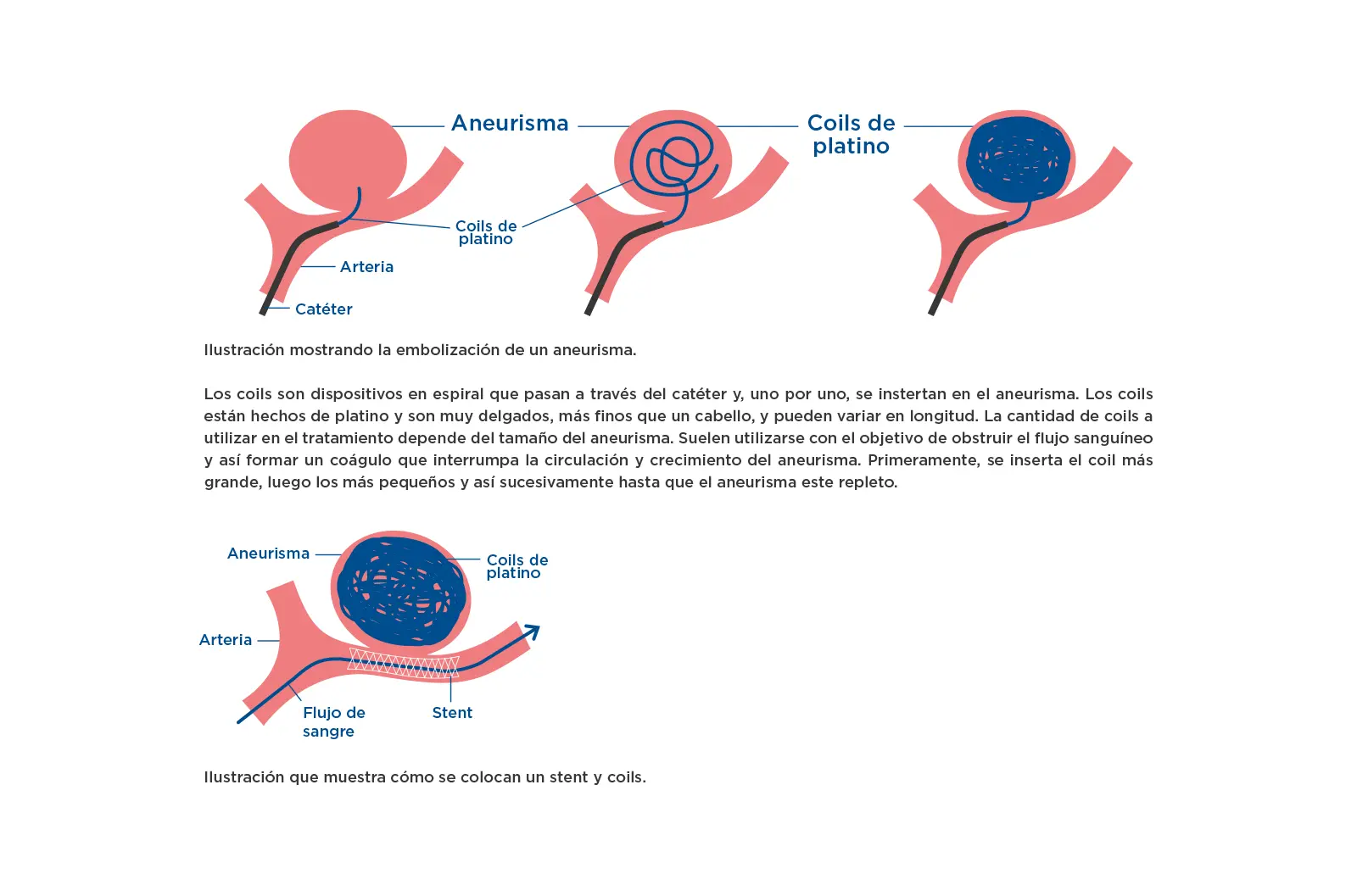 Un aneurisma cerebral puede desaparecer: ¿mito o realidad? - Cuánto puede vivir una persona con un aneurisma cerebral un aneurisma cerebral puede desaparecer - Cuánto puede vivir una persona con un aneurisma cerebral
