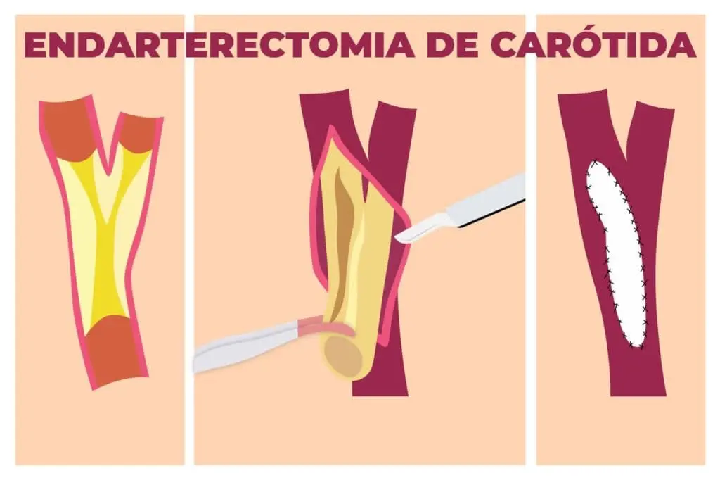 Endarterectomía Carotídea: Procedimiento, Riesgos y Recuperación - Cuánto tarda en cicatrizar la arteria carótida endarterectomia carotidea - Cuánto tarda en cicatrizar la arteria carótida