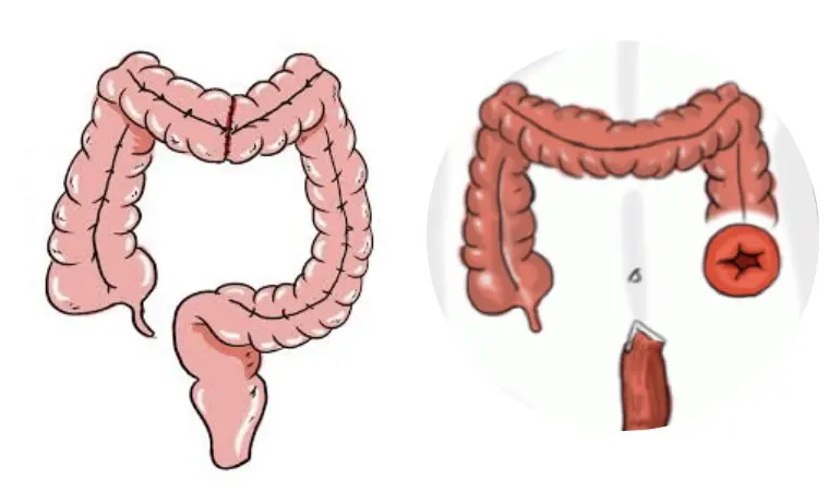 Reconexión de Intestino: Preguntas y Respuestas - Cuánto tarda en cicatrizar una unión de intestino reconexión de intestino preguntas y respuestas - Cuánto tarda en cicatrizar una unión de intestino