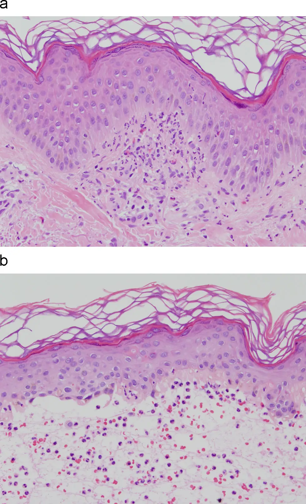 Dermatitis Herpetiforme: Diagnóstico, Tratamiento y Seguimiento - Cuánto tarda en curarse la dermatitis herpetiforme tratamiento para dermatitis herpetiforme - Cuánto tarda en curarse la dermatitis herpetiforme