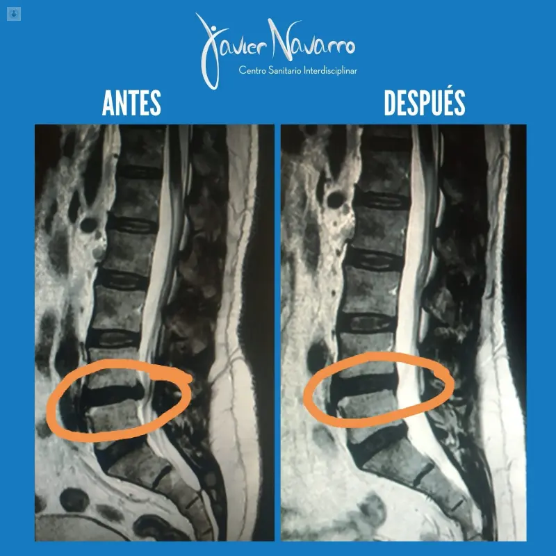 Hernia discal: Causas, síntomas y cuánto tarda en curarse - Cuánto tarda en curarse una hernia discal como se ve una hernia de disco - Cuánto tarda en curarse una hernia discal