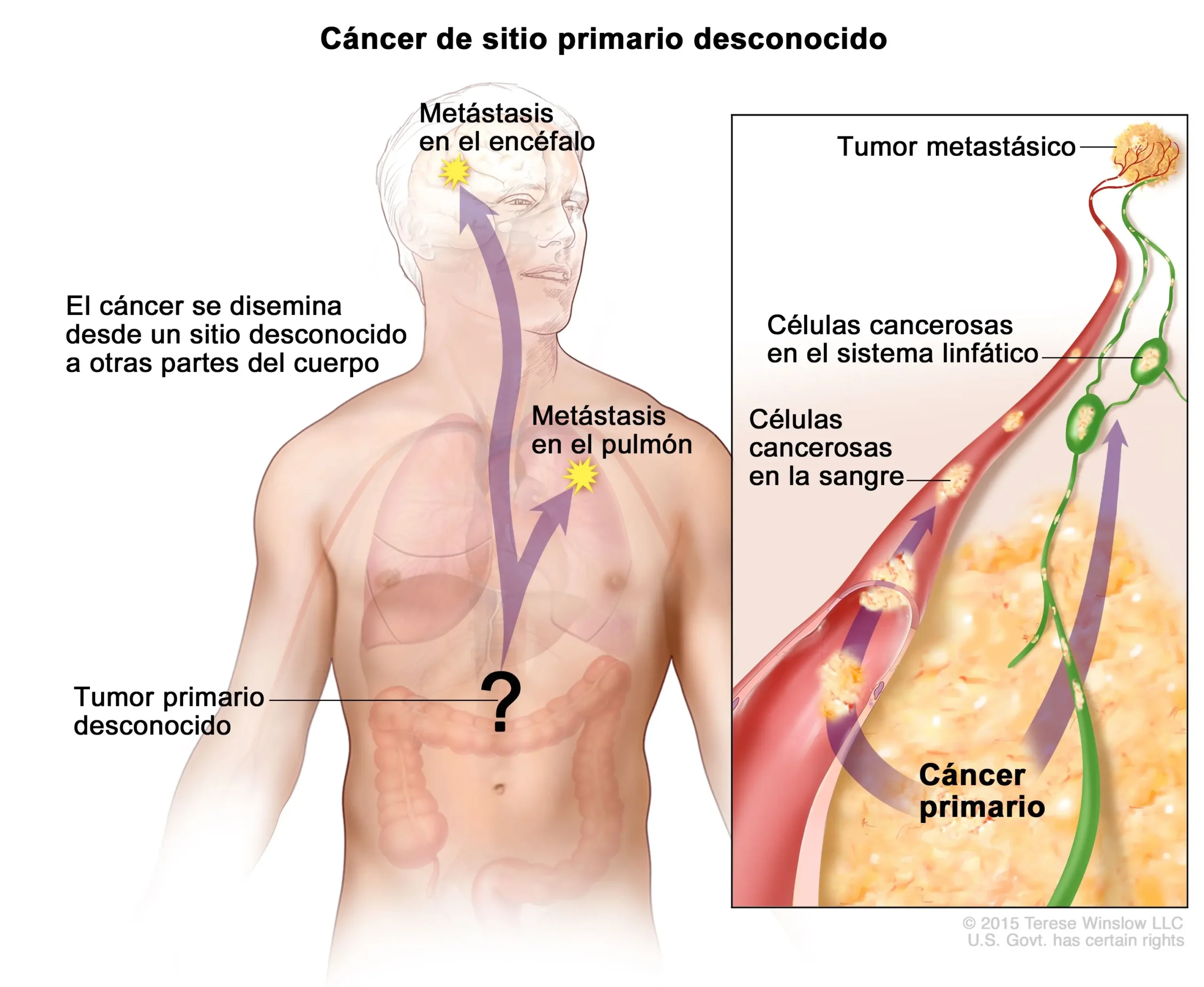 Proceso Neoformativo: Formación y Detección de Tumores - Cuánto tarda en formarse un tumor proceso neoformativo - Cuánto tarda en formarse un tumor