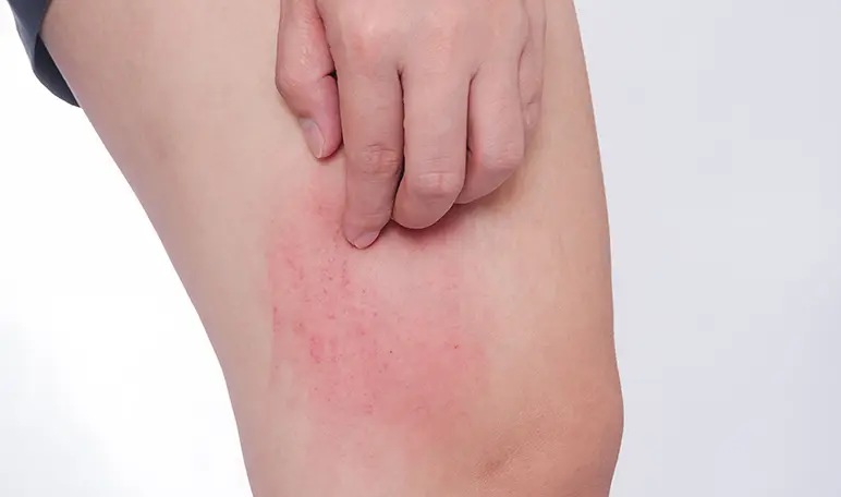 Picaduras de garrapata en niños: qué debes saber sobre la enfermedad de Lyme y cómo prevenirla - Cuánto tarda en hacer efecto una picadura de garrapata picadura de garrapata en niños - Cuánto tarda en hacer efecto una picadura de garrapata