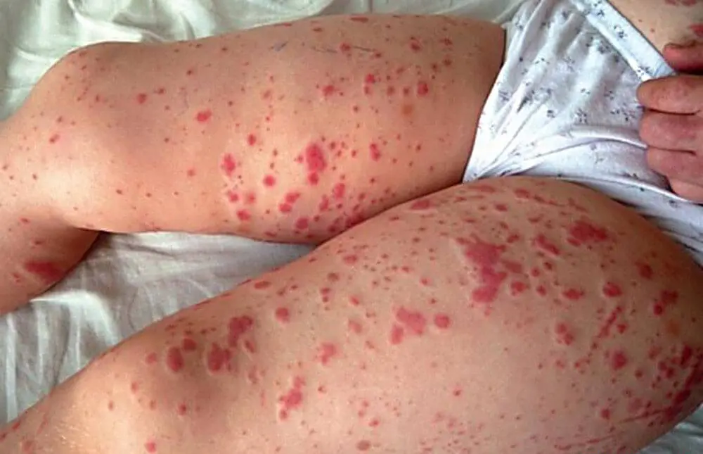 Púrpura de Henoch: Causas, Síntomas y Tratamiento - Cuánto tarda en irse la púrpura alergia purpura - Cuánto tarda en irse la púrpura
