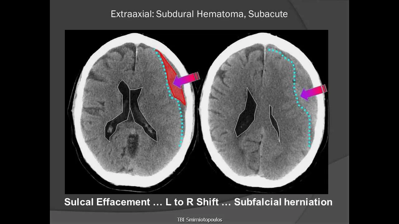 Hematomas subdurales: Causas, síntomas, diagnóstico y tratamiento - Cuánto tarda en sanar un hematoma subdural hematoma subdural - Cuánto tarda en sanar un hematoma subdural