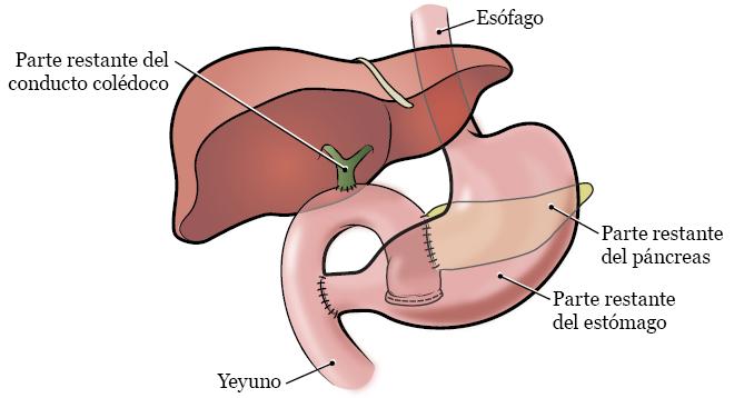 Cirugía de Whipple: Todo lo que necesitas saber - Cuánto tardas en recuperarte de una operación de páncreas cirugia whipple - Cuánto tardas en recuperarte de una operación de páncreas