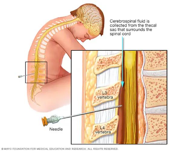 Punción Lumbar: Procedimiento, Riesgos y Resultados - Cuánto tiempo de reposo después de una punción lumbar puncion lumbar - Cuánto tiempo de reposo después de una punción lumbar