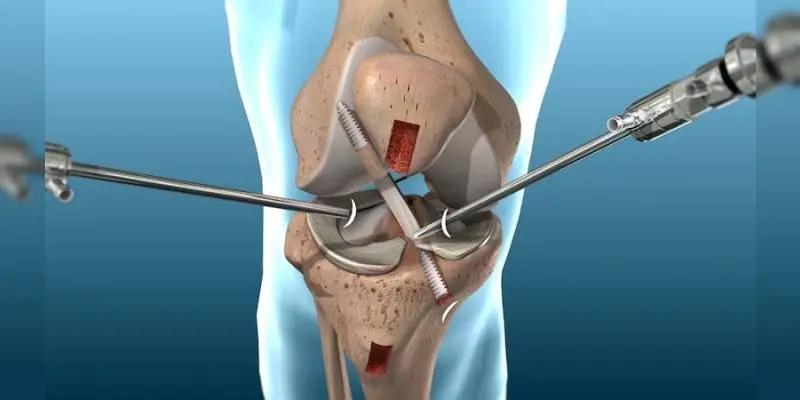 cirugia de rodilla - Cuánto tiempo después de una cirugía de rodilla puedo caminar