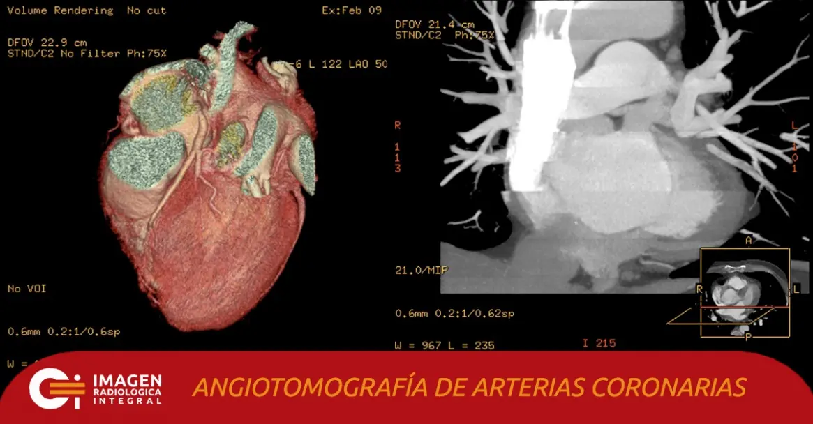 angiotomografia coronaria - Cuánto tiempo dura el angiotac coronario