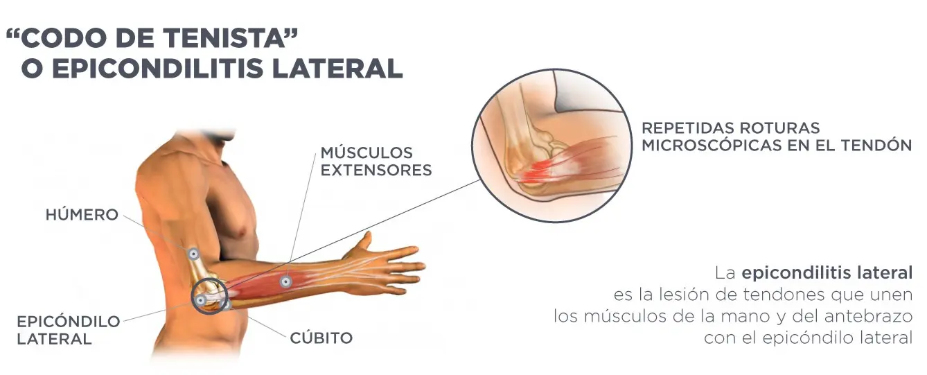 Codo de tenista: causas, síntomas, tratamiento y prevención - Cuánto tiempo dura el codo de tenista codo de tenista - Cuánto tiempo dura el codo de tenista