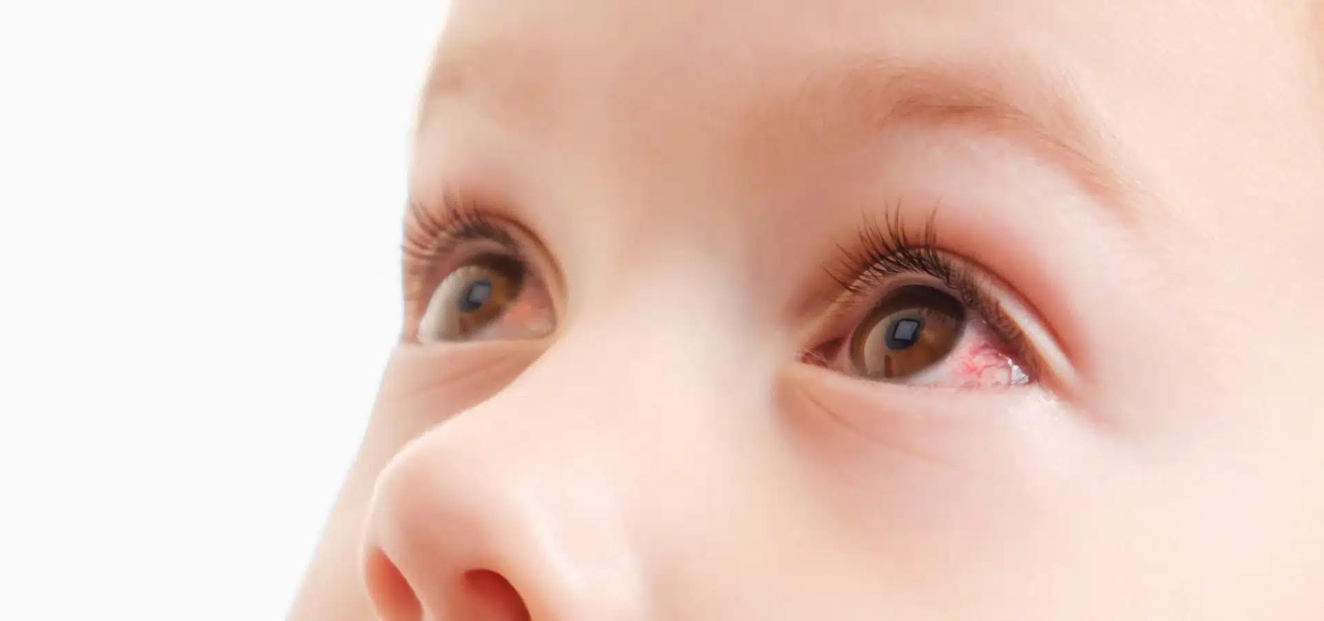 Ojos Rojos en Niños: Conjuntivitis, Causas, Tratamiento y Prevención - Cuánto tiempo dura el ojo rojo en niños ojos rojos en niños - Cuánto tiempo dura el ojo rojo en niños