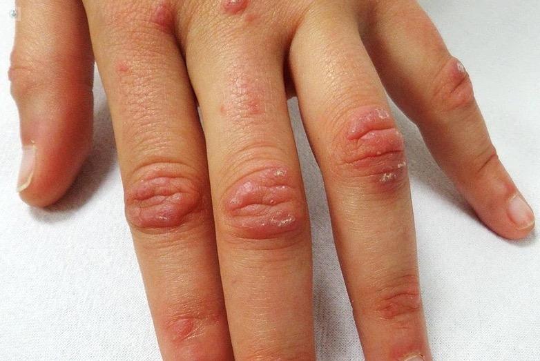 que es la dermatomiositis - Cuánto tiempo dura la dermatomiositis