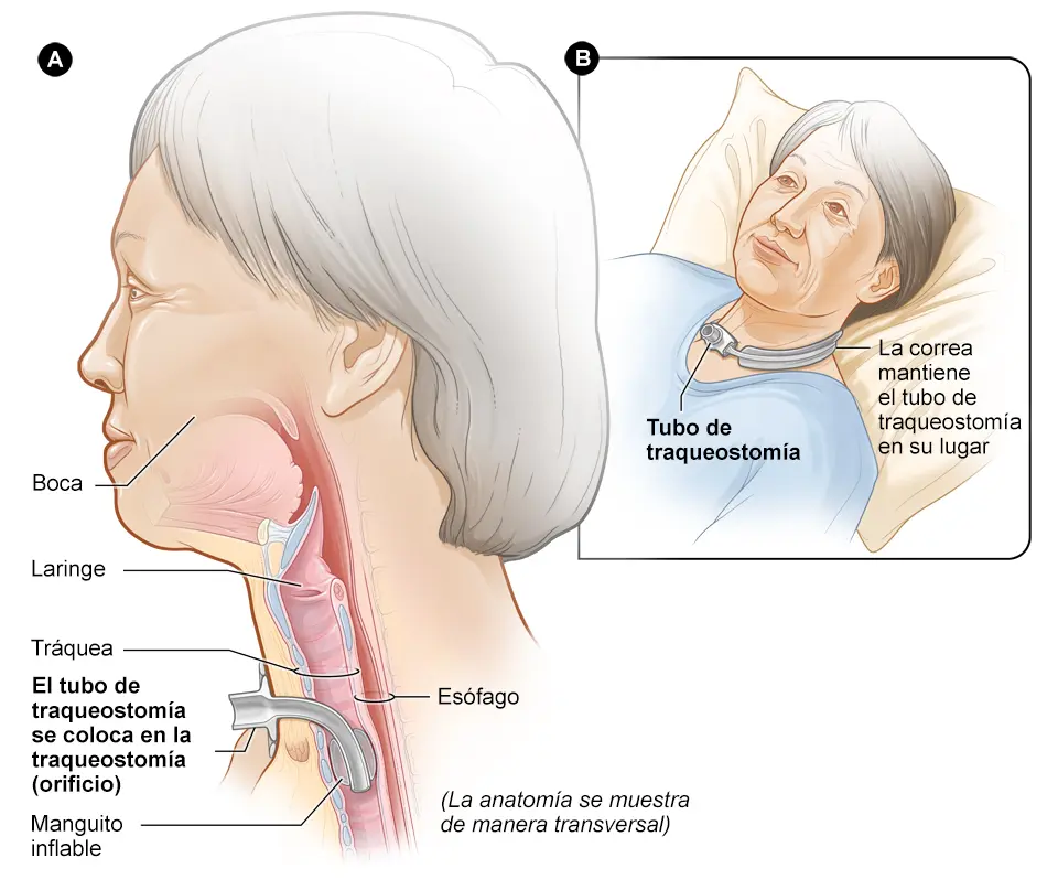 Insuficiencia Respiratoria Crónica: Causas, Síntomas y Tratamiento - Cuánto tiempo dura la insuficiencia respiratoria insuficiencia respiratoria cronica - Cuánto tiempo dura la insuficiencia respiratoria