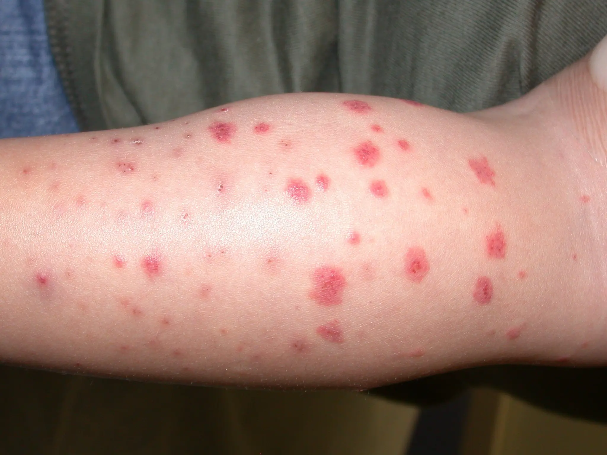 purpura de schonlein henoch sap - Cuánto tiempo dura la púrpura en niños