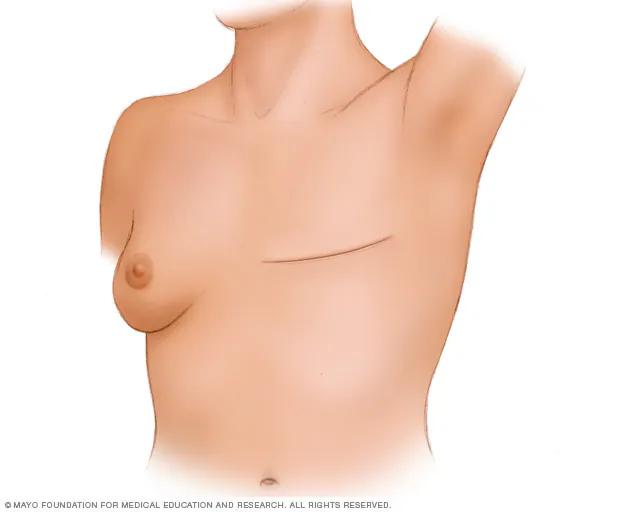 Cirugía de Cáncer de Mama: Riesgos, Tipos y Recuperación - Cuánto tiempo dura la recuperación después de la cirugía de cáncer de mama operacion de cancer de mama - Cuánto tiempo dura la recuperación después de la cirugía de cáncer de mama