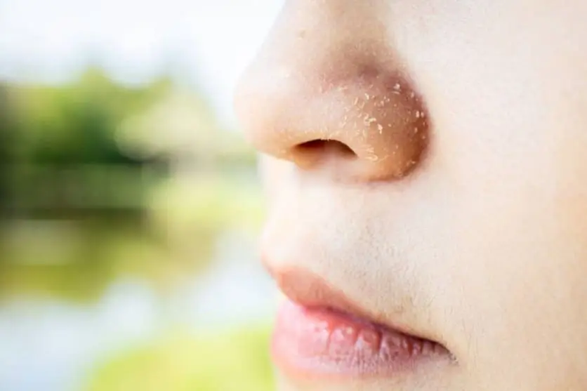 Dermatitis Seborreica en la Nariz: Causas, Síntomas y Tratamientos - Cuánto tiempo dura un brote de dermatitis seborreica dermatitis seborreica nariz - Cuánto tiempo dura un brote de dermatitis seborreica