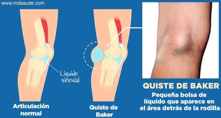 Quiste de Baker: Duración, Tratamiento y Preguntas Frecuentes - Cuánto tiempo dura un quiste de Baker el quiste de baker es cancerigeno - Cuánto tiempo dura un quiste de Baker