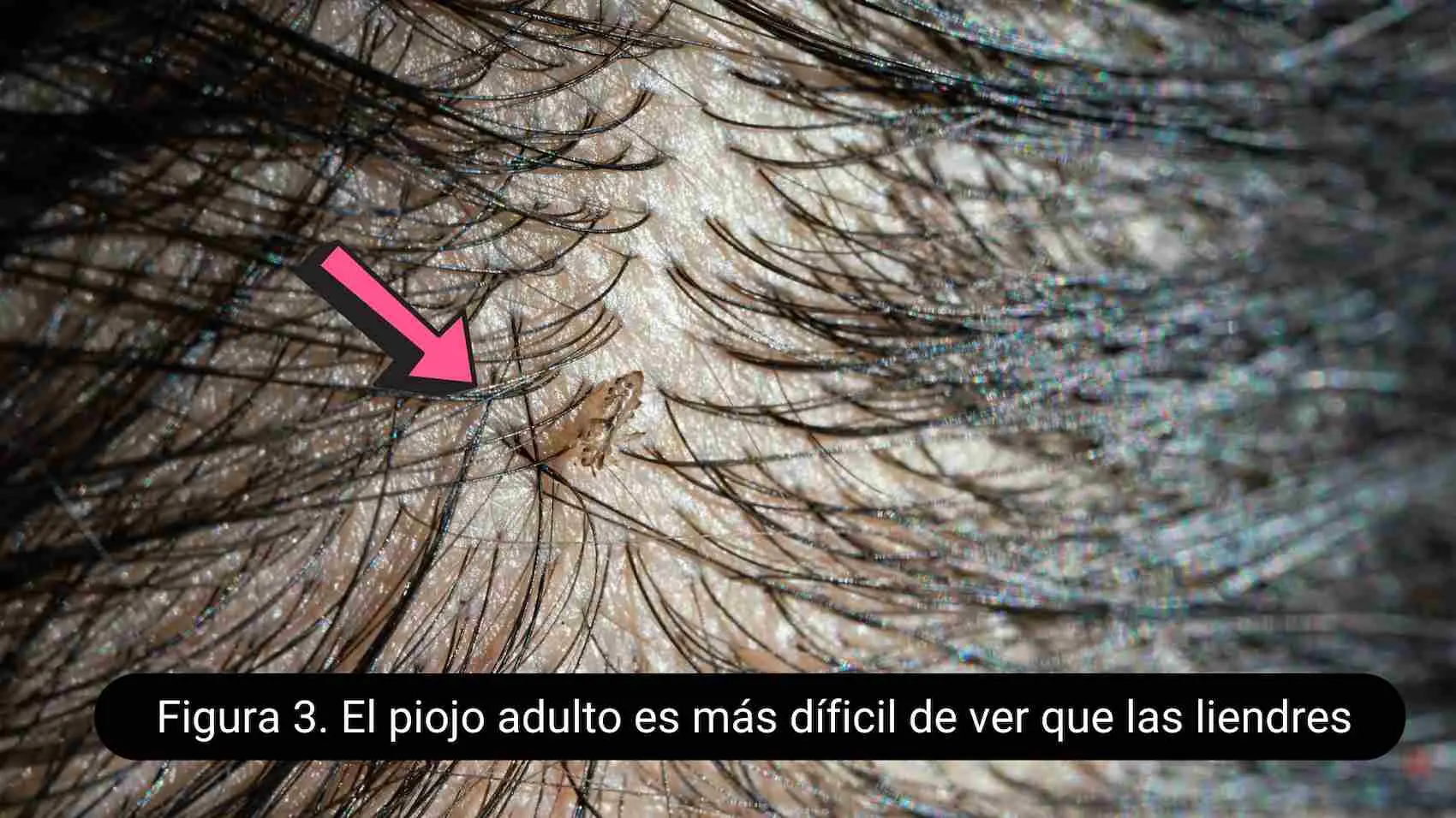 Cómo Eliminar los Piojos de la Cabeza: Guía Completa para la Infestación - Cuánto tiempo pueden durar los piojos en la cabeza piojos en la cabeza - Cuánto tiempo pueden durar los piojos en la cabeza