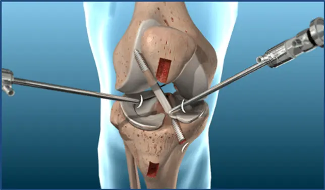 Operación de Ligamento Cruzado: Todo lo que necesitas saber - Cuánto tiempo puedo estar con el ligamento cruzado roto operacion de ligamentos cruzados - Cuánto tiempo puedo estar con el ligamento cruzado roto