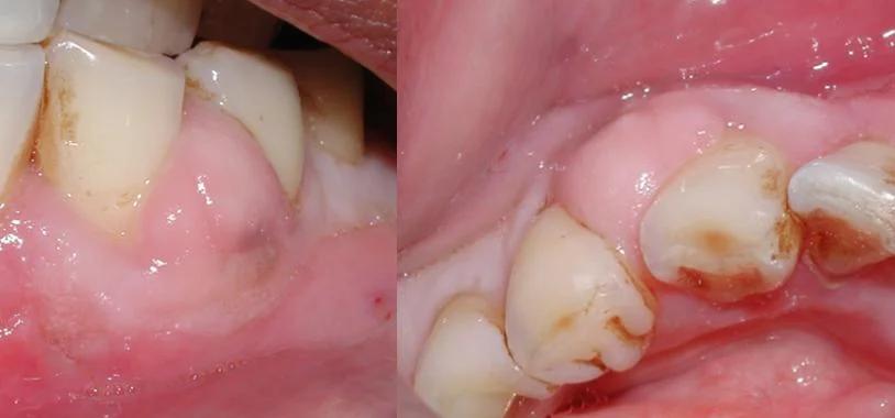 Absceso Dental: Síntomas, Causas y Tratamiento - Cuánto tiempo se puede estar con un absceso dental síntomas de absceso dental - Cuánto tiempo se puede estar con un absceso dental