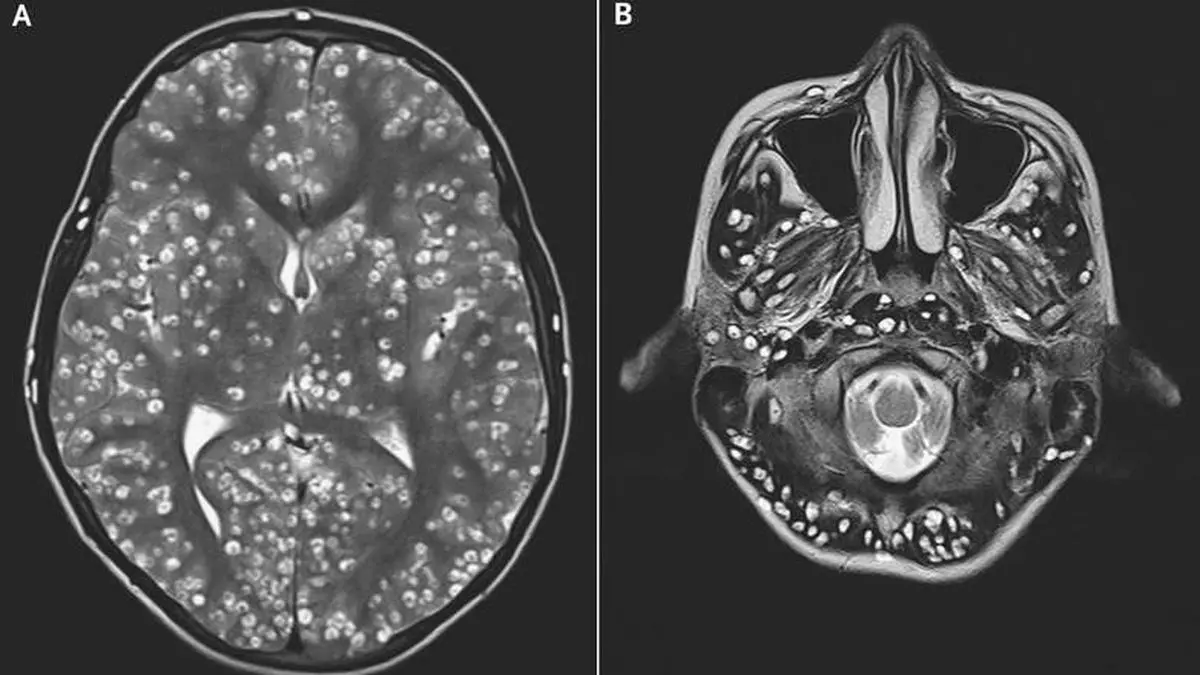Cisticercosis Cerebral: Una Enfermedad Grave y Prevenible - Cuánto tiempo se puede vivir con cisticercosis cisticercosis cerebral - Cuánto tiempo se puede vivir con cisticercosis