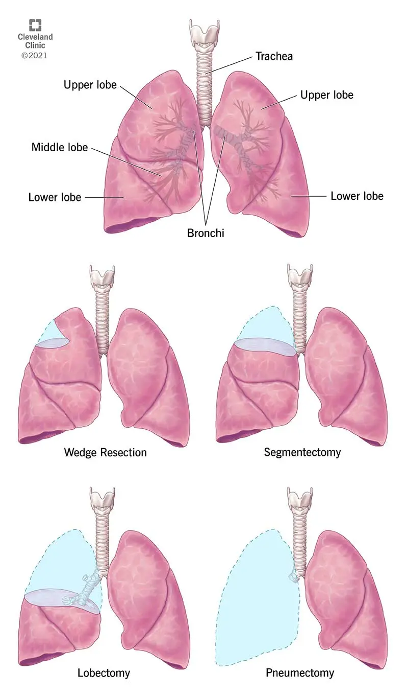 Cómo eliminar nódulos pulmonares: Guía completa para pacientes - Cuánto tiempo se tarda en extirpar un nódulo pulmonar como eliminar nodulos pulmonares - Cuánto tiempo se tarda en extirpar un nódulo pulmonar