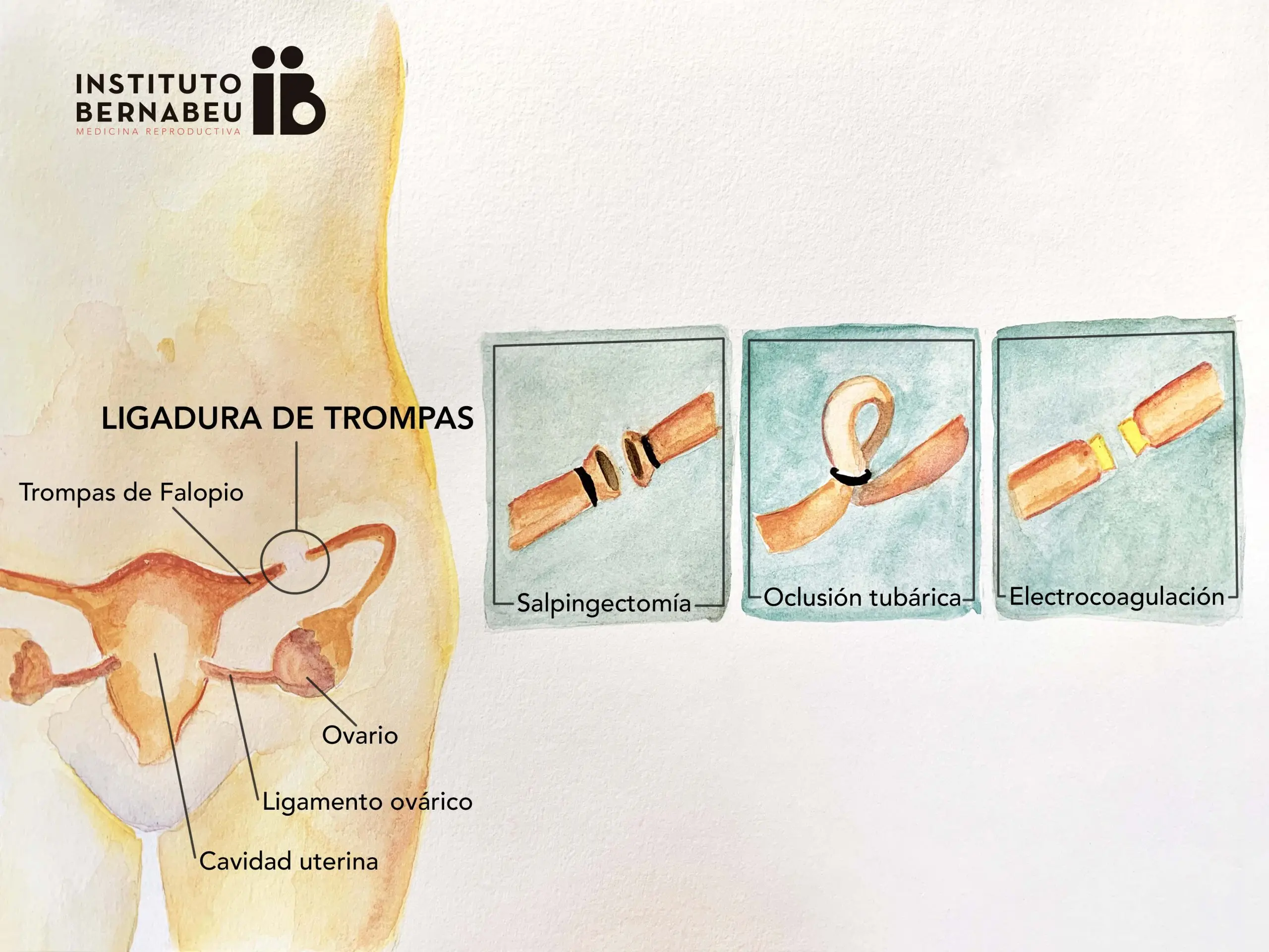 Ligadura de Trompas y Cesárea: Efectos Secundarios y Recuperación - Cuánto tiempo tarda en cicatrizar una ligadura de trompas por cesárea cesarea y ligadura de trompas efectos secundarios - Cuánto tiempo tarda en cicatrizar una ligadura de trompas por cesárea