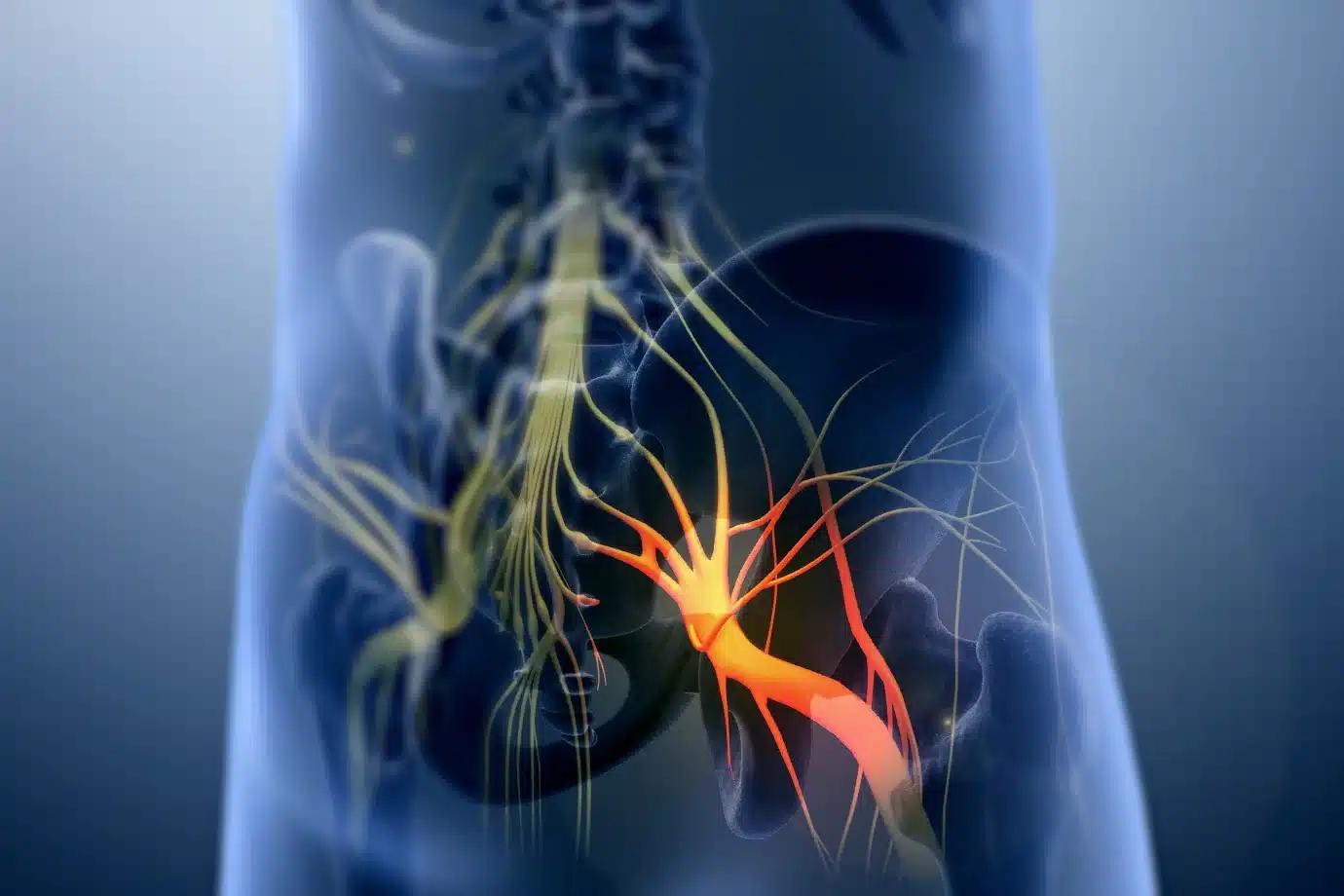Dolor del Nervio Ciático: Causas, Síntomas y Tratamientos - Cuánto tiempo tarda en desinflamar el nervio ciático dolor nervio ciatico - Cuánto tiempo tarda en desinflamar el nervio ciático
