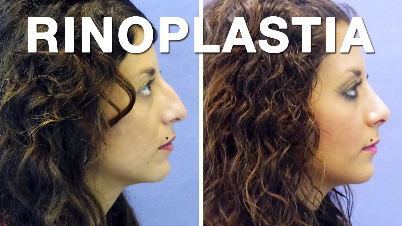 Septoplastia: Antes y Después de la Cirugía Nasal - Cuánto tiempo tarda en recuperarse de una septoplastia septoplastia antes y despues - Cuánto tiempo tarda en recuperarse de una septoplastia