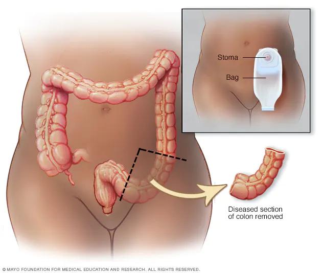 operacion de intestino - Cuánto tiempo tarda en sanar una cirugía de intestino