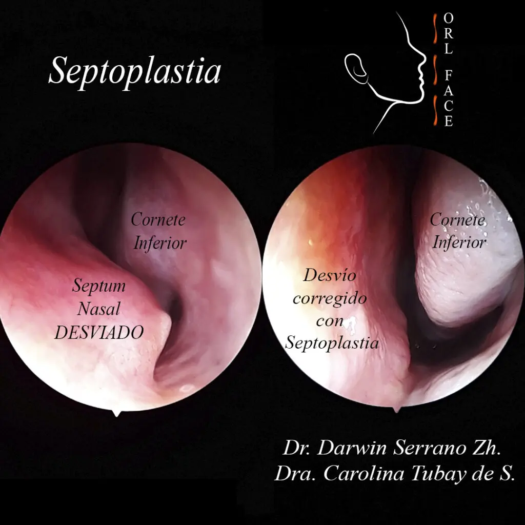 Septoplastia: Qué es, recuperación, riesgos y alternativas - Cuánto tiempo tarda la recuperación de una septoplastia septoplastia - Cuánto tiempo tarda la recuperación de una septoplastia