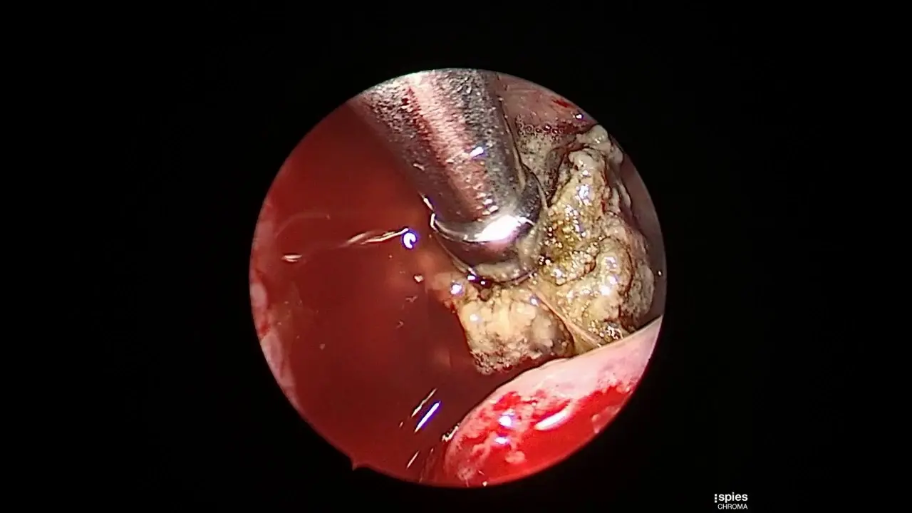 Operación de Sinusitis: Todo lo que Necesitas Saber - Cuánto vale una operación de sinusitis operacion de sinusitis - Cuánto vale una operación de sinusitis
