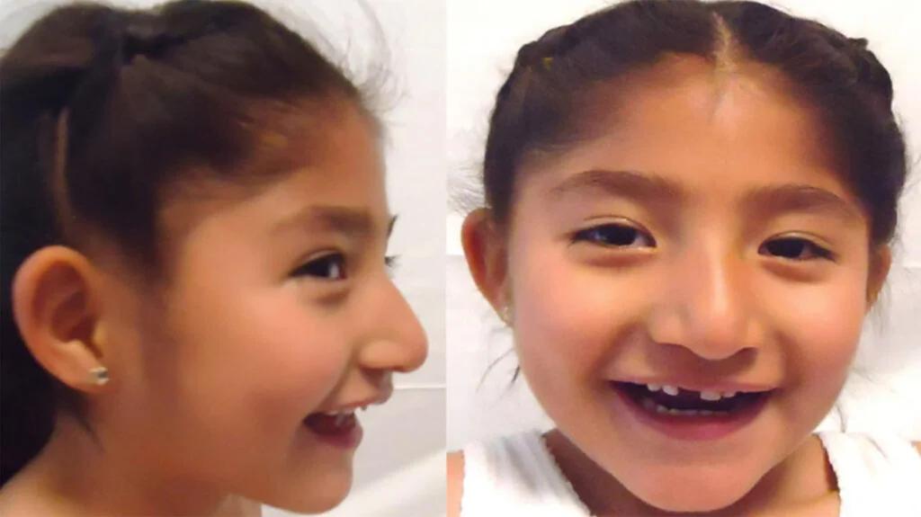 Síndrome de Angelman: Una mirada profunda a esta condición genética - Cuánto vive una persona con Angelman angelman - Cuánto vive una persona con Angelman