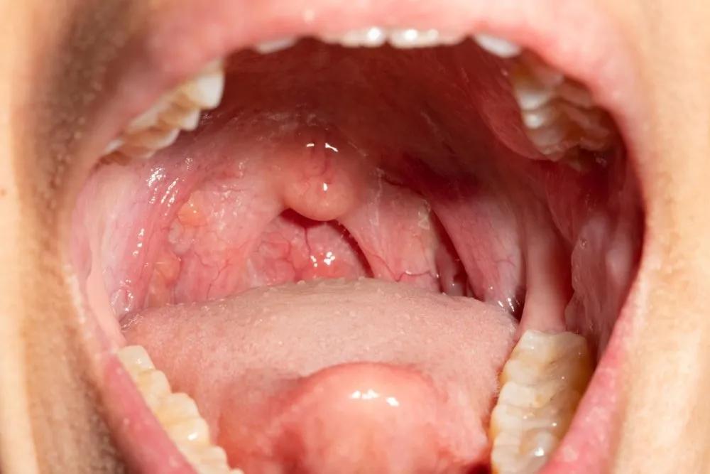 Cáncer de Orofaringe: Síntomas, Estadísticas y Supervivencia - Cuánto vive una persona con cáncer de orofaringe cancer de orofaringe sintomas - Cuánto vive una persona con cáncer de orofaringe