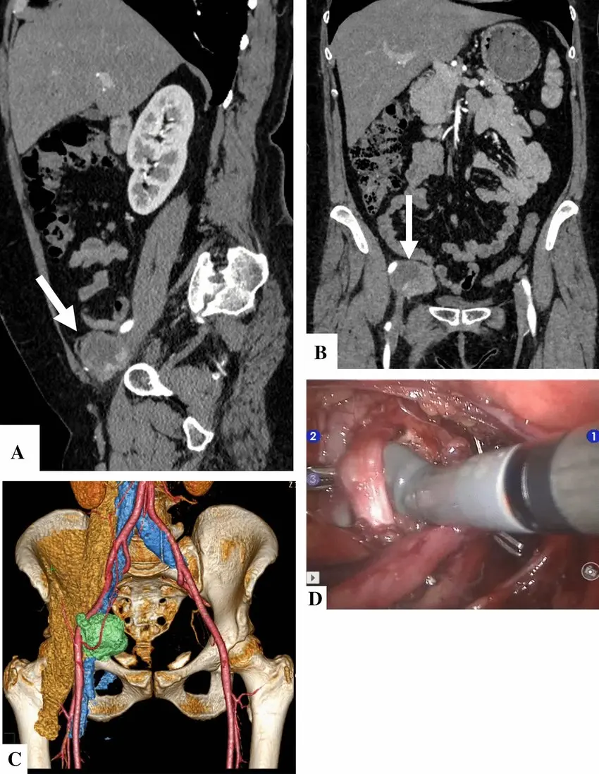 Tumor Retroperitoneal: Un Reto para la Salud - Cuánto vive una persona con cáncer retroperitoneal tumor retroperitoneal - Cuánto vive una persona con cáncer retroperitoneal