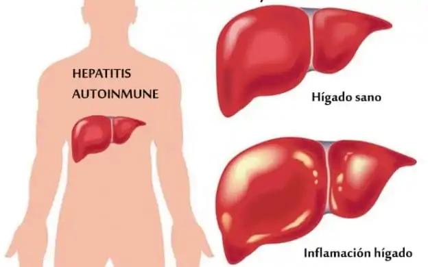Cirrosis Hepática Autoinmune: Una Guía Completa - Cuánto vive una persona con cirrosis autoinmune cirrosis autoinmune - Cuánto vive una persona con cirrosis autoinmune