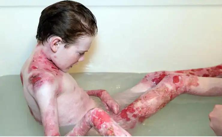 Epidermólisis bullosa: Una mirada profunda a esta rara condición de la piel - Cuánto vive una persona con epidermólisis bullosa epidermolisis - Cuánto vive una persona con epidermólisis bullosa