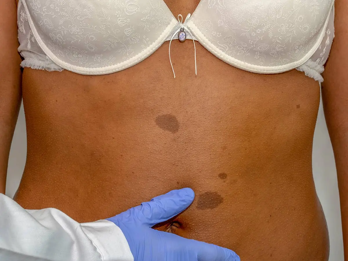 Neurofibroma: Causas, Síntomas y Tratamiento - Cuánto vive una persona con neurofibromatosis tipo 1 neurofibroma - Cuánto vive una persona con neurofibromatosis tipo 1