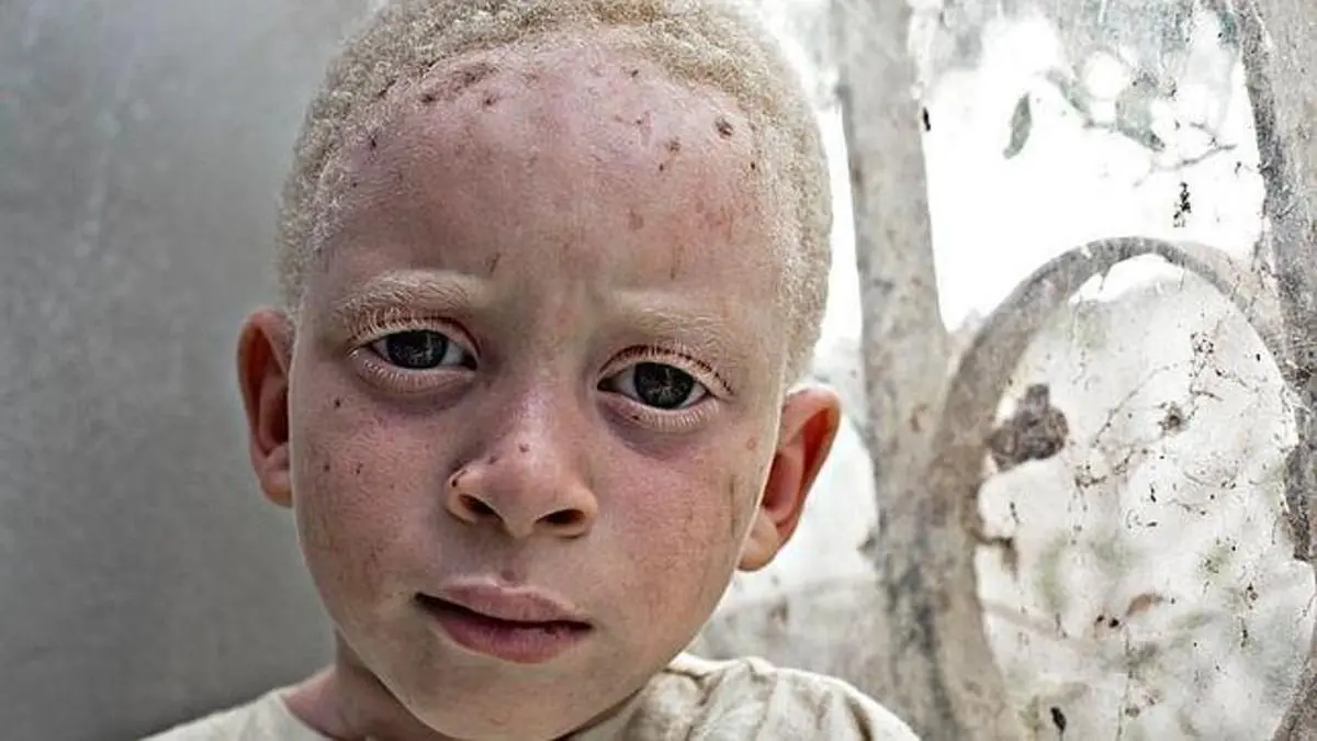 negros albinos - Cuántos albinos hay en Puerto Rico