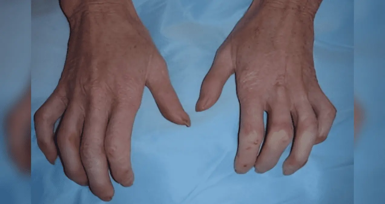 Síndrome de CREST: Causas, Síntomas y Evolución - Cuántos años puedes vivir con esclerodermia sindrome de crest - Cuántos años puedes vivir con esclerodermia