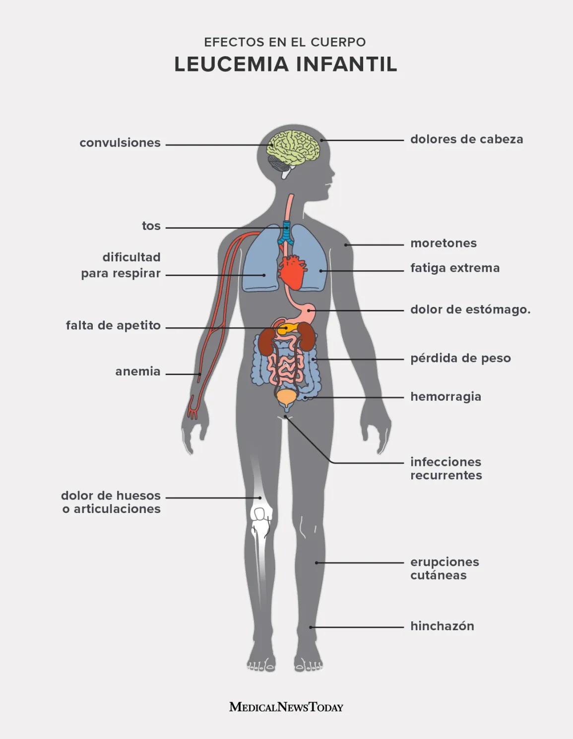 Leucemias Infantiles: Esperanza y Supervivencia - Cuántos años viven los niños con leucemia leucemias infantiles - Cuántos años viven los niños con leucemia