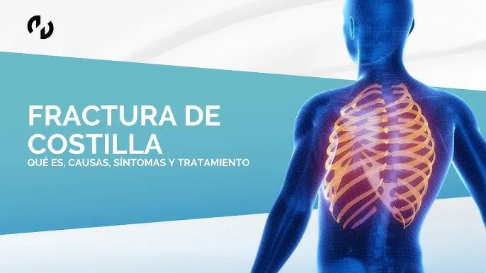 Fractura de Costilla: Causas, Síntomas, Tratamiento y Prevención - Cuántos días de incapacidad por fractura de costillas fractura de costilla tratamiento - Cuántos días de incapacidad por fractura de costillas