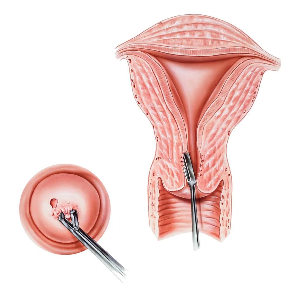 Biopsia de Cuello Uterino: Qué Esperar, Riesgos y Resultados - Cuántos días de reposo después de una biopsia del cuello uterino biopsia de cuello uterino - Cuántos días de reposo después de una biopsia del cuello uterino