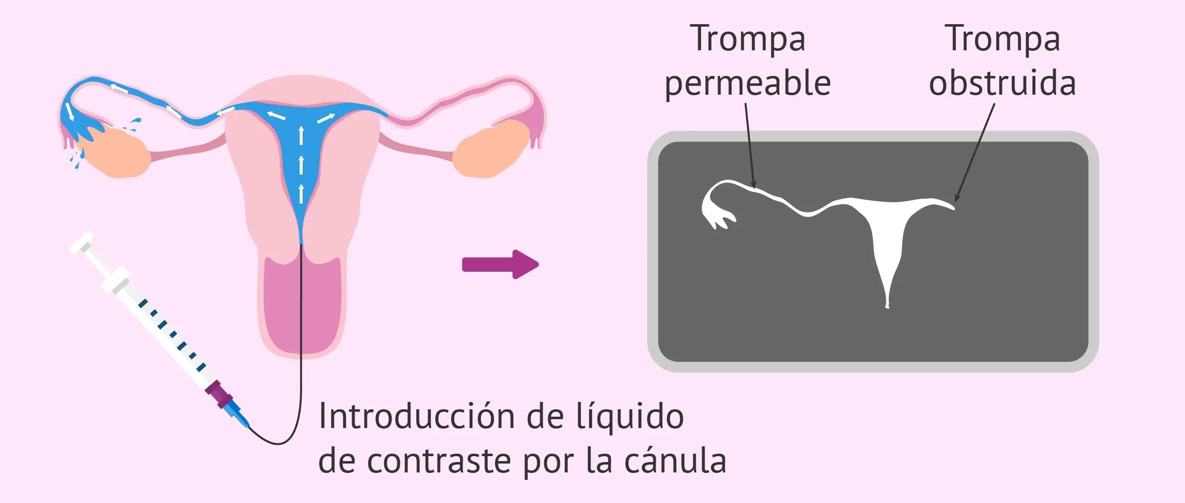 Prueba de Cotte: Cuántos días después de la histerosalpingografía puedo tener relaciones - Cuántos días después de la histerosalpingografía puedo tener relaciones prueba de cotte - Cuántos días después de la histerosalpingografía puedo tener relaciones