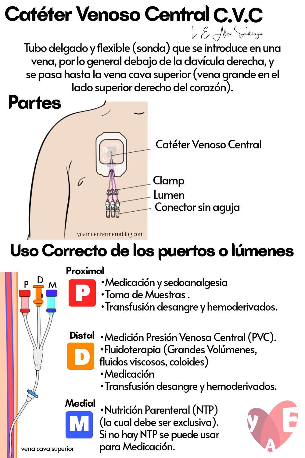 Catéter Venoso Central: Una Guía Completa - Cuántos días dura una vía central via central - Cuántos días dura una vía central