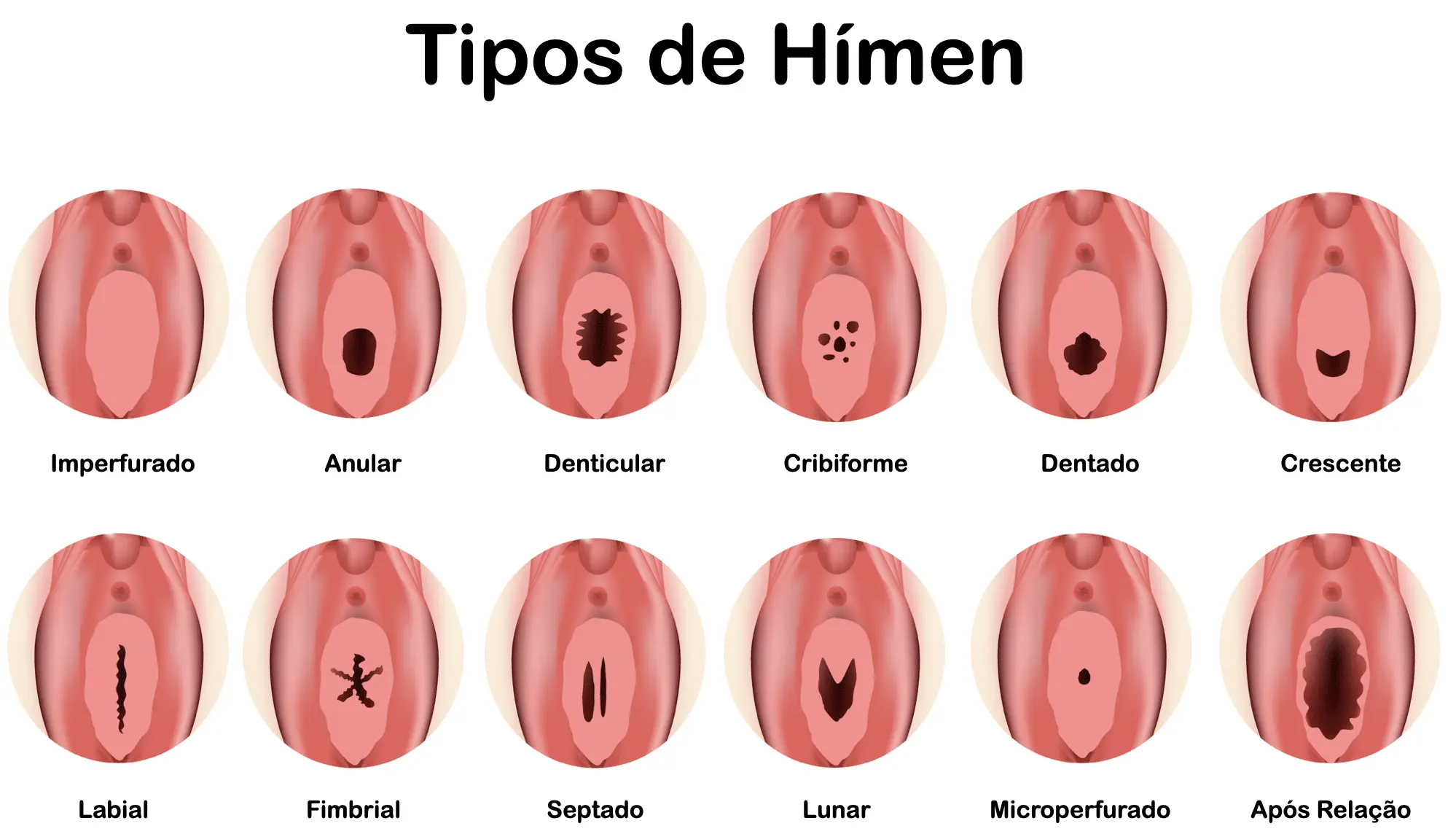 Tipos de Himen: Una Guía Completa para Entender esta Membrana - Cuántos tipos de himen hay y cuáles son tipos de himen - Cuántos tipos de himen hay y cuáles son