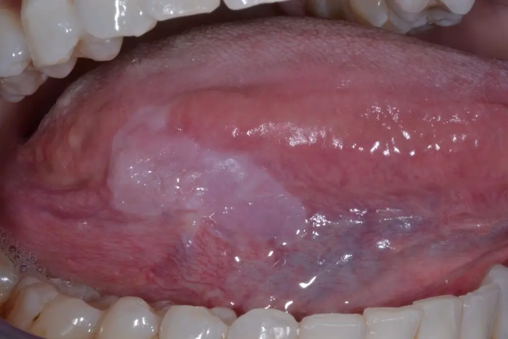 Leucoplasia Oral: Causas, Síntomas, Tipos y Tratamiento - Cuántos tipos de leucoplasia hay leucoplasia oral - Cuántos tipos de leucoplasia hay