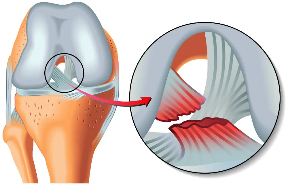 Rotura de Ligamentos: ¿Se Puede Caminar? - Dónde duele la rotura de ligamentos con rotura de ligamentos se puede caminar - Dónde duele la rotura de ligamentos