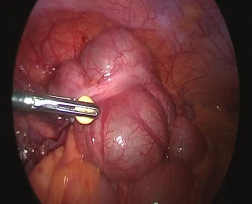 Tumor Carcinoide: Qué es, Síntomas y Tratamiento - Dónde es más frecuente el tumor carcinoide tumor carcinoide - Dónde es más frecuente el tumor carcinoide