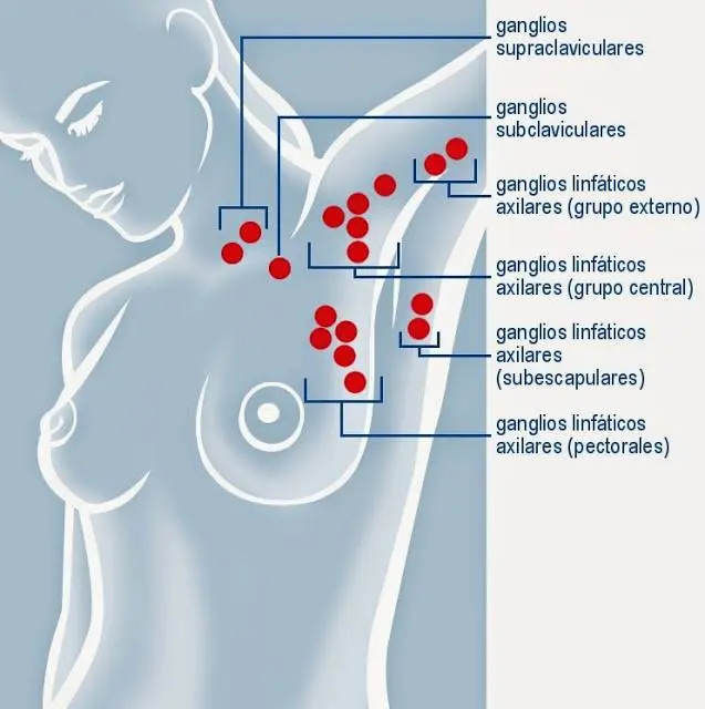 Ganglios Linfáticos Axilares: Anatomía, Función y Relevancia en el Cáncer de Mama - Dónde están ubicados los ganglios en la axila ganglios linfaticos axilares - Dónde están ubicados los ganglios en la axila
